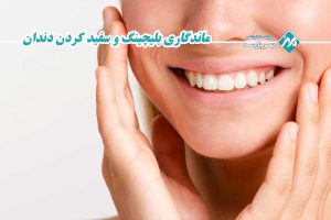 ماندگاری بلیچینگ و سفید کردن دندان