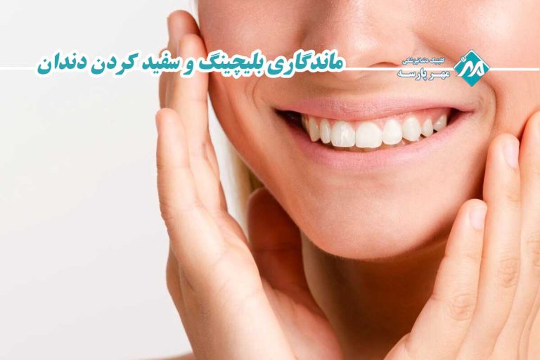ماندگاری بلیچینگ و سفید کردن دندان