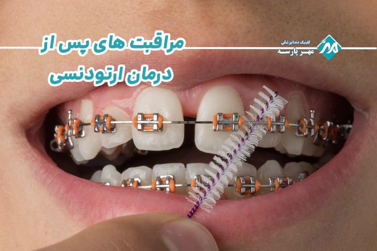 مراقبت های پس از درمان ارتودنسی