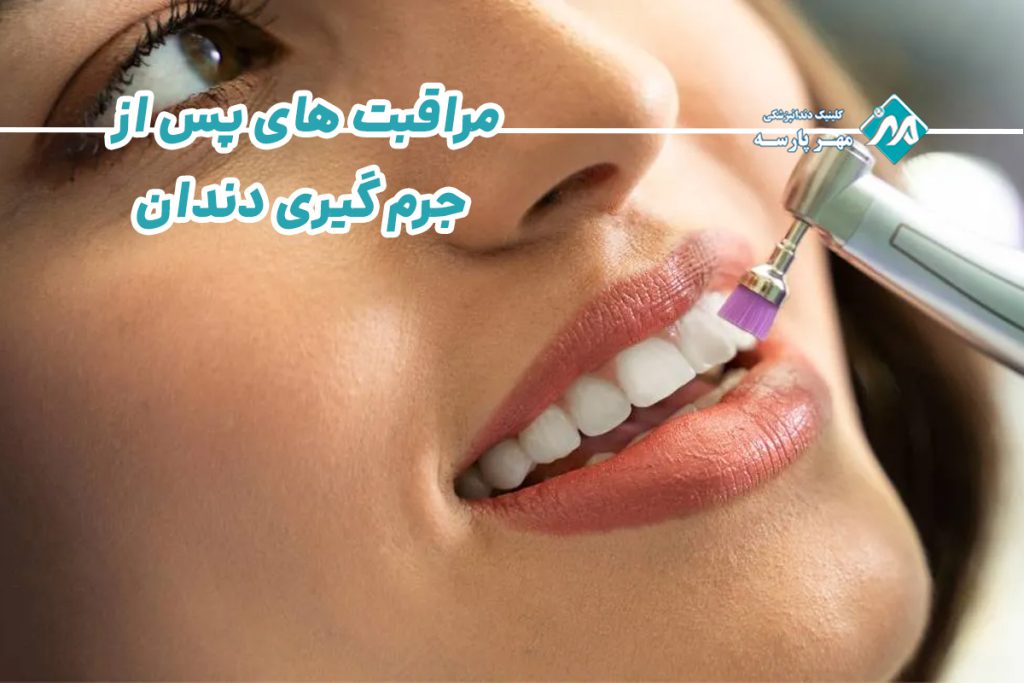 مراقبت های پس از جرم گیری دندان
