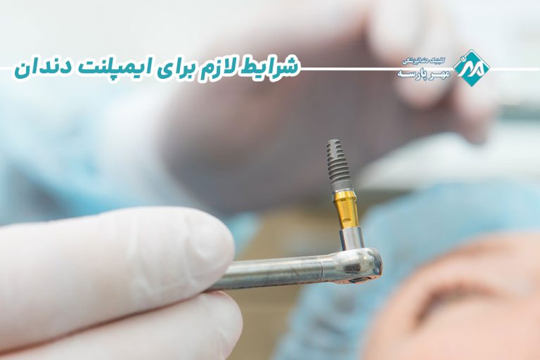 شرایط لازم برای ایمپلنت دندان