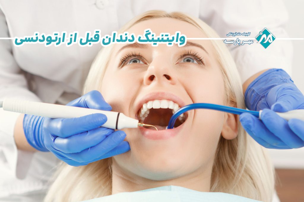 وایتنینگ دندان قبل از ارتودنسی