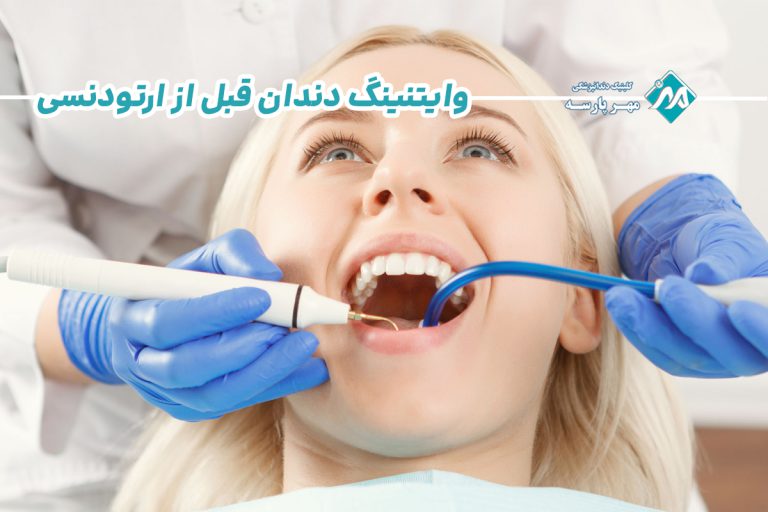 وایتنینگ دندان قبل از ارتودنسی