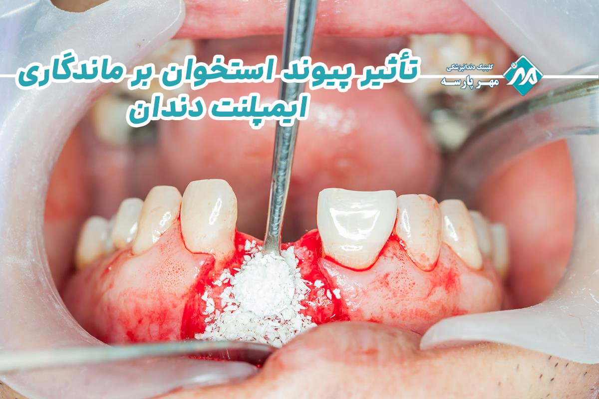 تأثیر پیوند استخوان بر ماندگاری ایمپلنت دندان