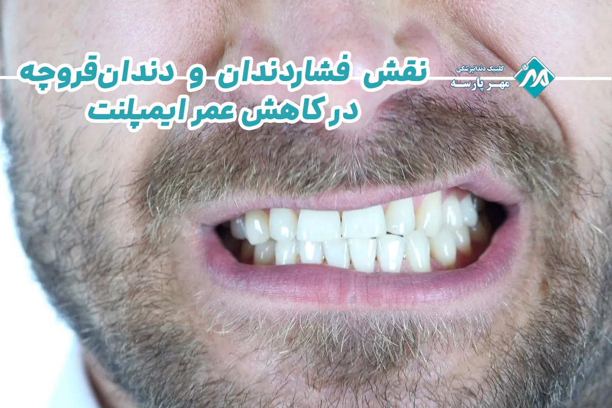 نقش فشاردندان و دندانقروچه در کاهش عمر ایمپلنت