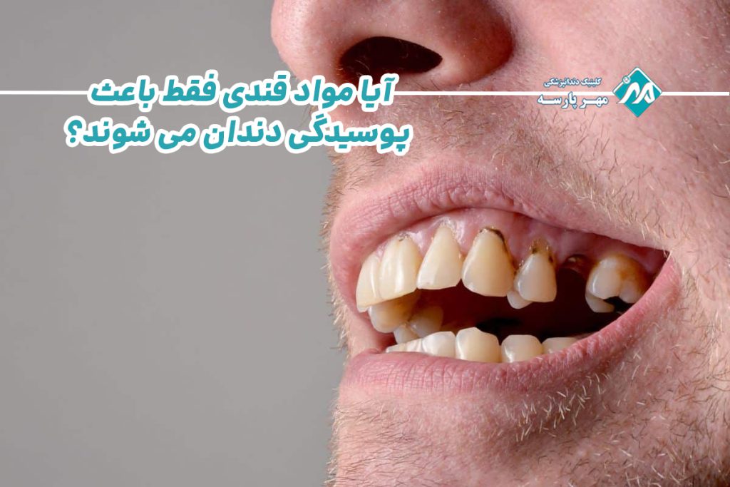 پوسیدگی دندان