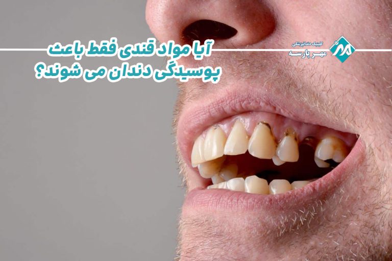 پوسیدگی دندان