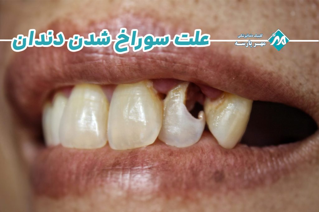 سوراخ شدن دندان