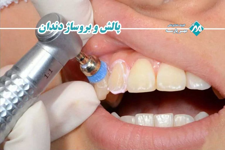 پالش و بروساژ دندان