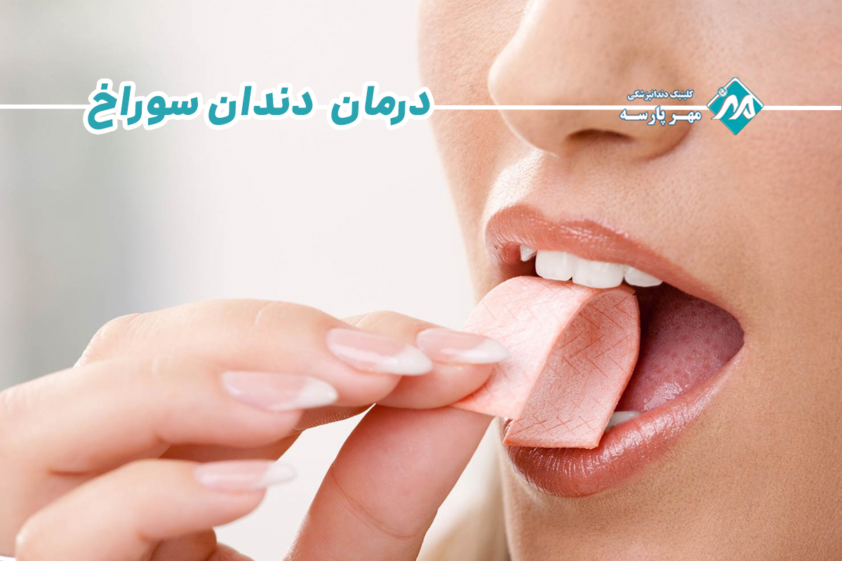 درمان دندان سوراخ