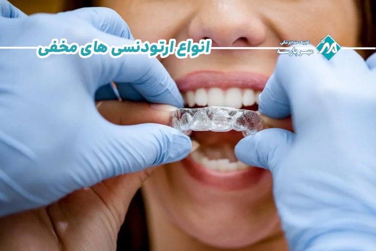 انواع ارتودنسی های مخفی