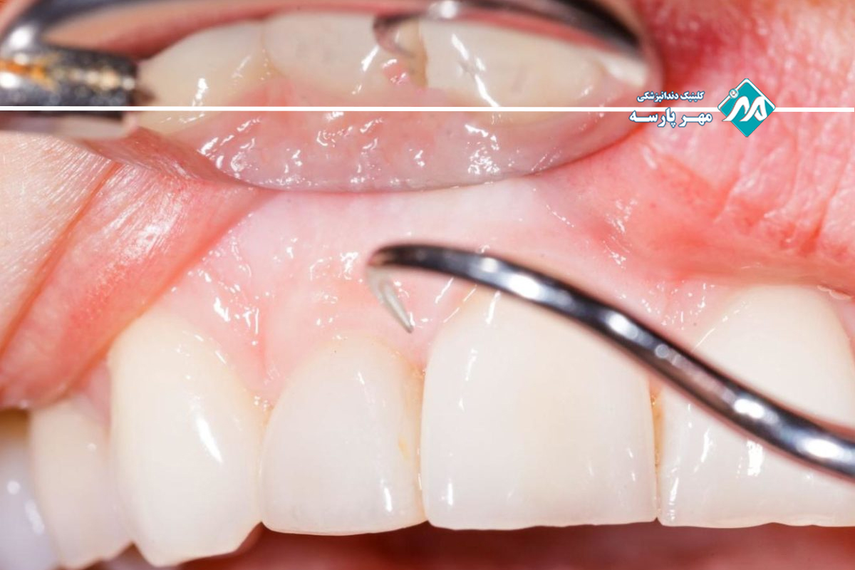 انواع جراحی لثه ملتهب