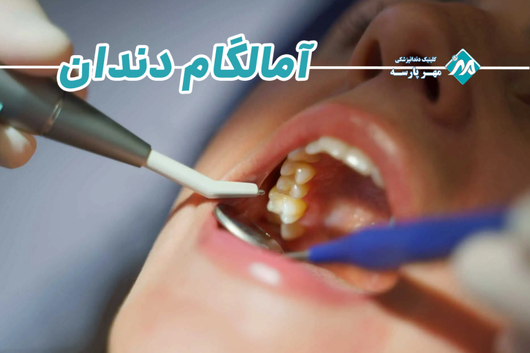 آمالگام دندان