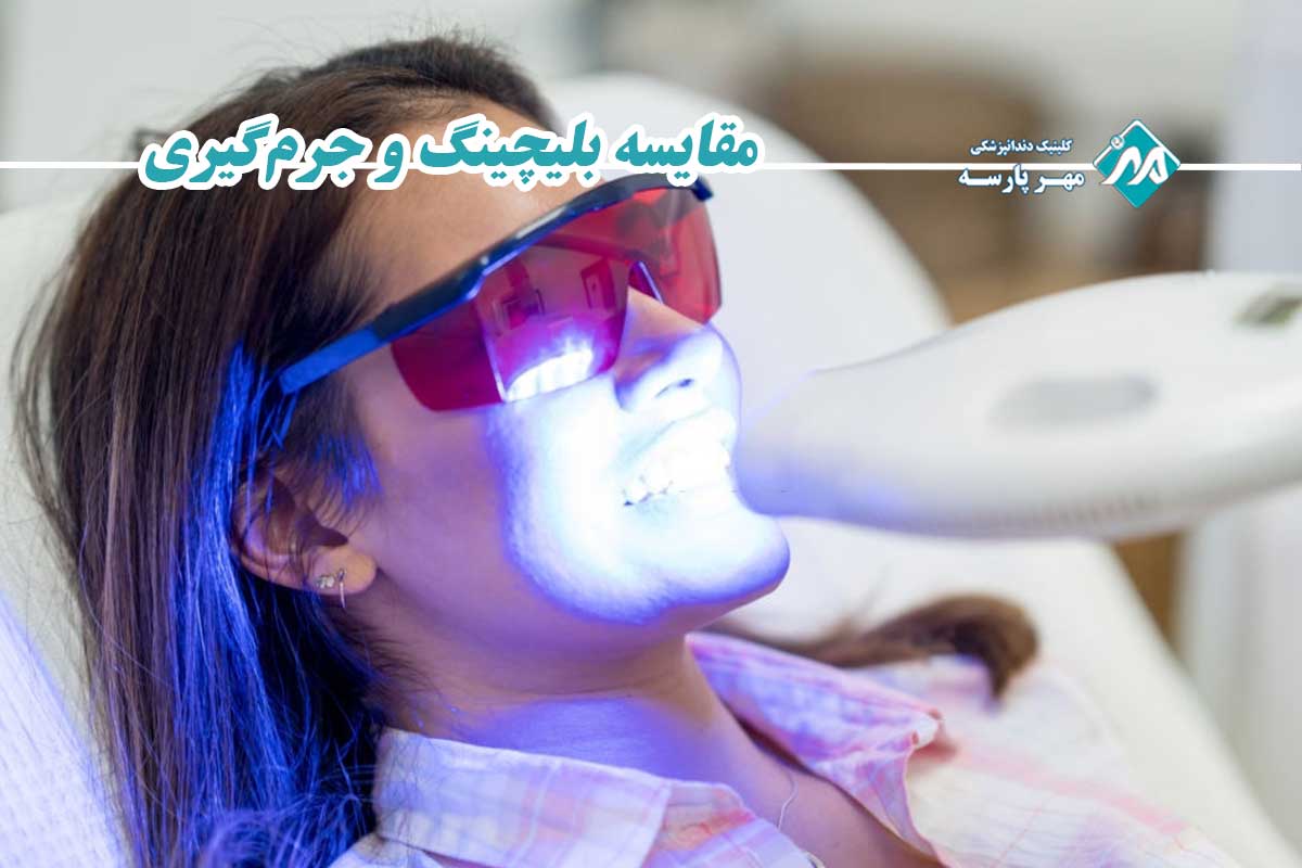 تفاوت بلیچینگ با جرم گیری دندان