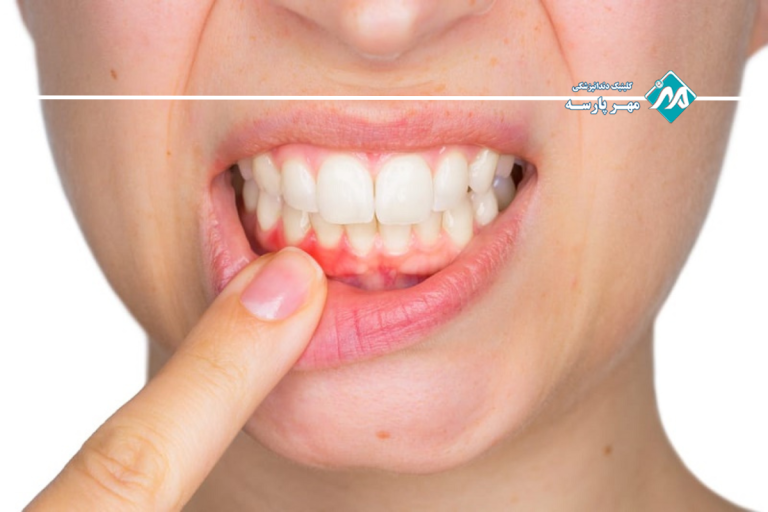 روش های انجام پیوند لثه