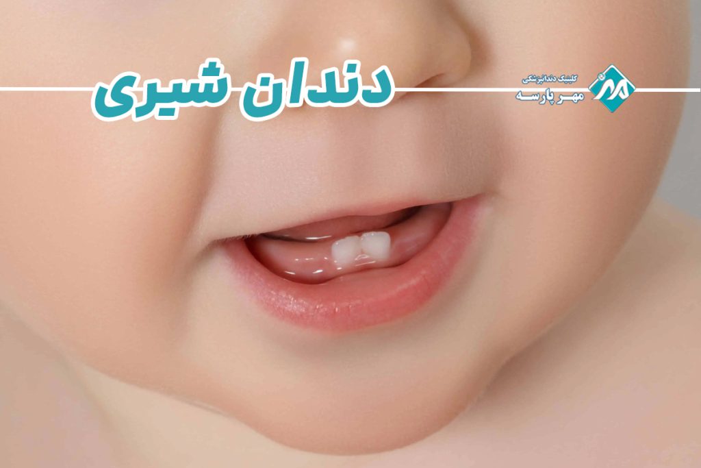 دندان شیری