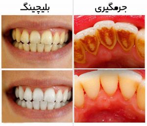 فواید جرم گیری دندان