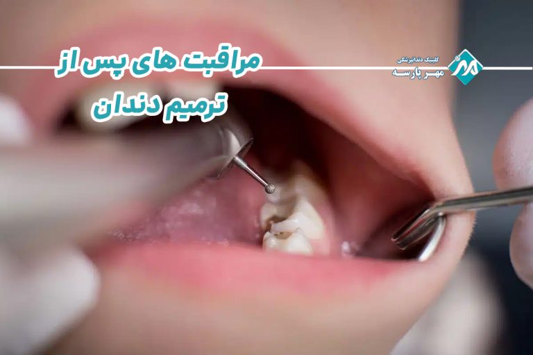نکات مهم مراقبت پس از ترمیم دندان