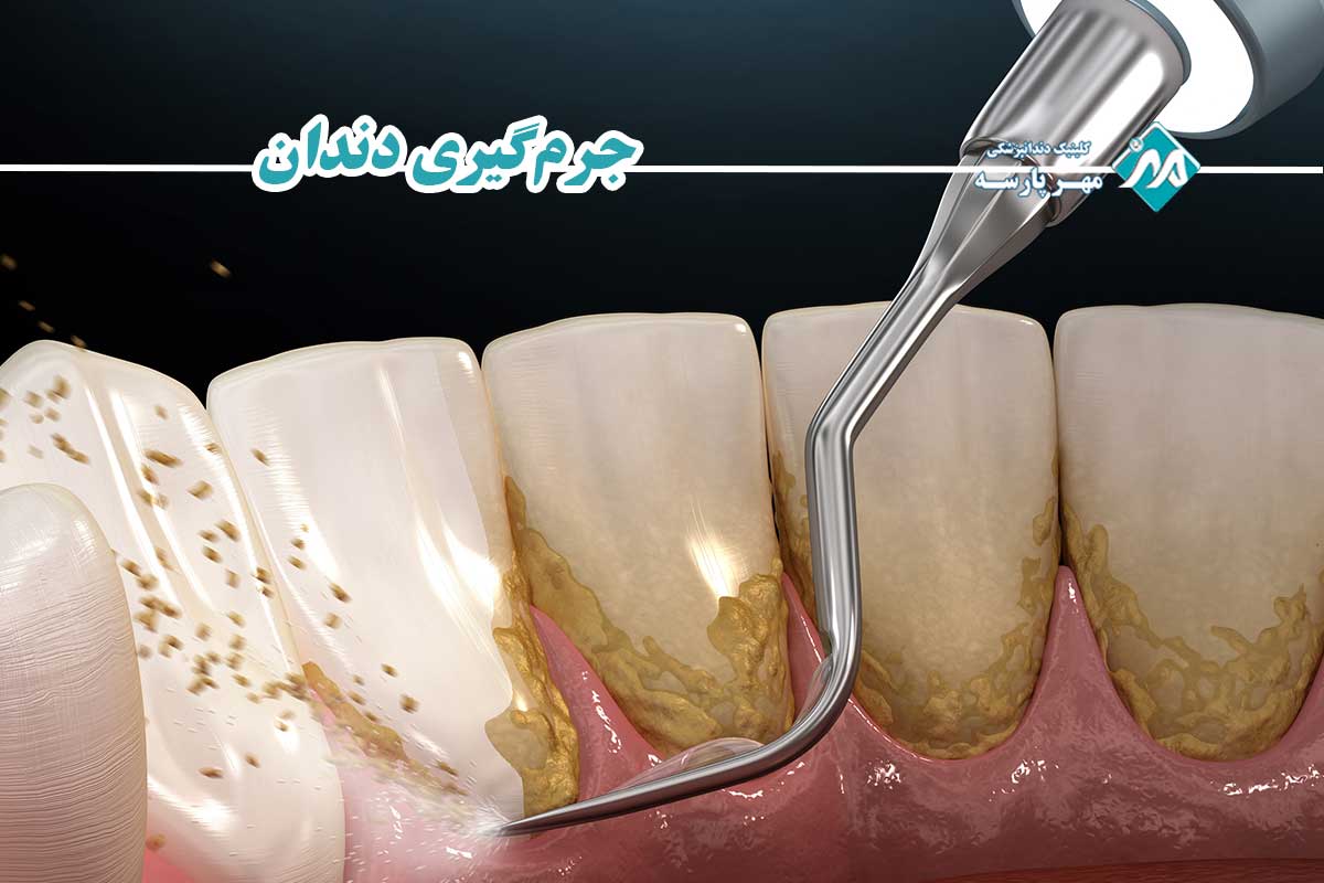 جرم گیری دندان چیست و چرا یک ضرورت پزشکی برای حفظ سلامت دهان و دندان است؟