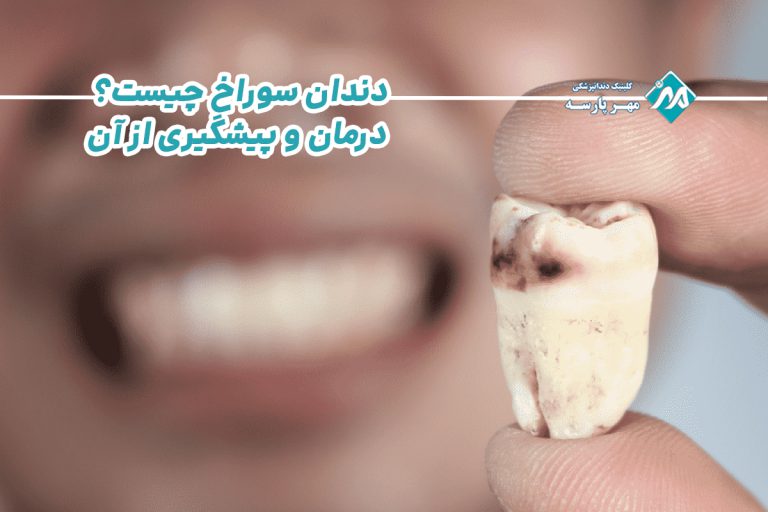 دندان سوراخ