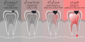 درمان ریشه دندان عفونی