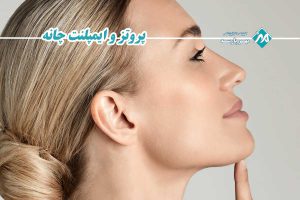 ایمپلنت چانه