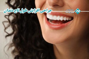 افزایش طول تاج دندان
