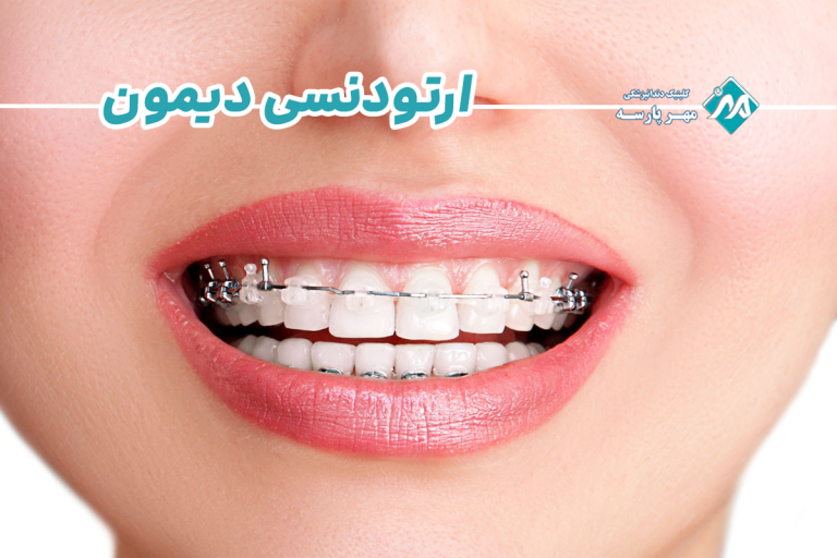 ارتودنسی دیمون