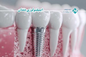 ایمپلنتولوژی دندان