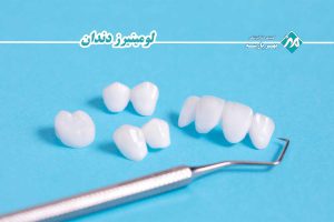 لومینیرز دندان