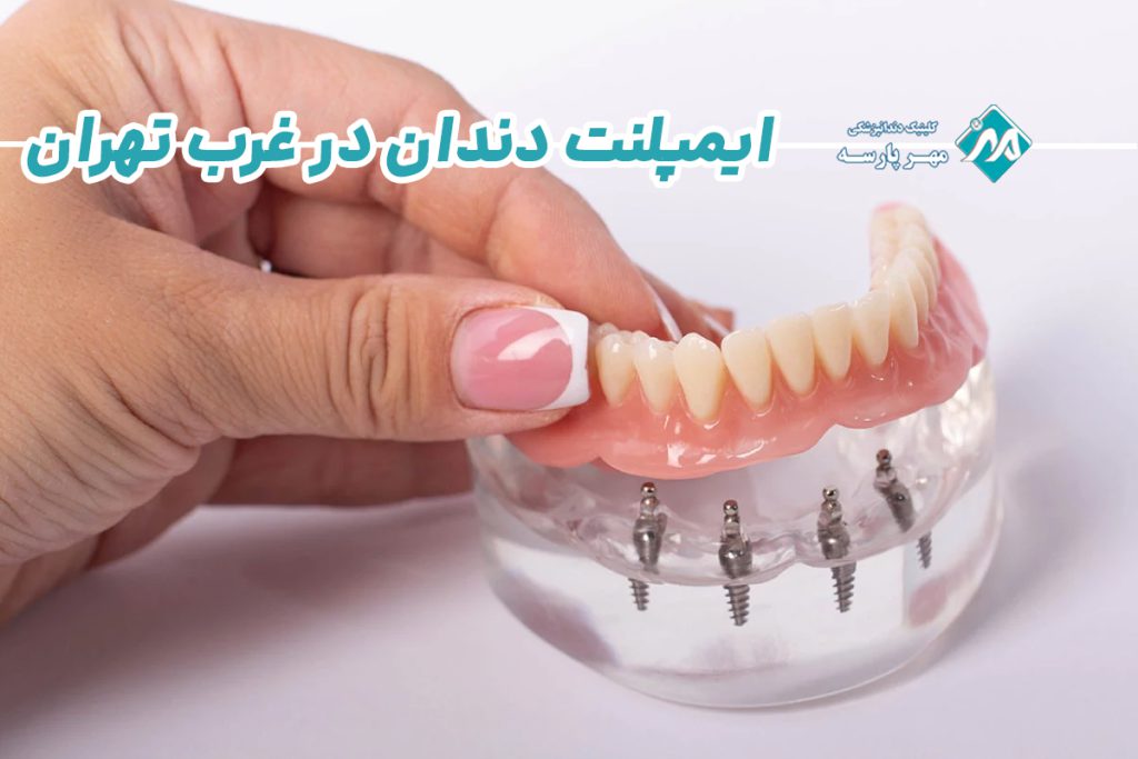 ایمپلنت دندان در غرب تهران