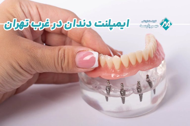 ایمپلنت دندان در غرب تهران