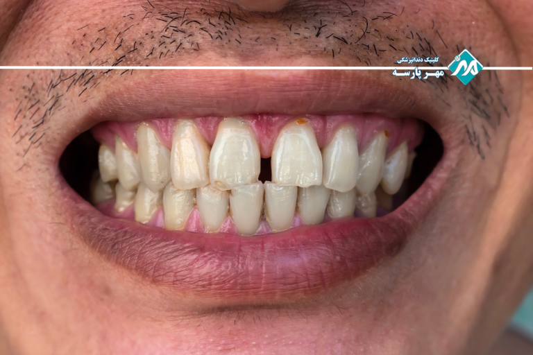 گپ بین دو دندان