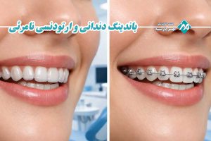 مقایسه باندینگ دندانی و ارتودنسی نامرئی