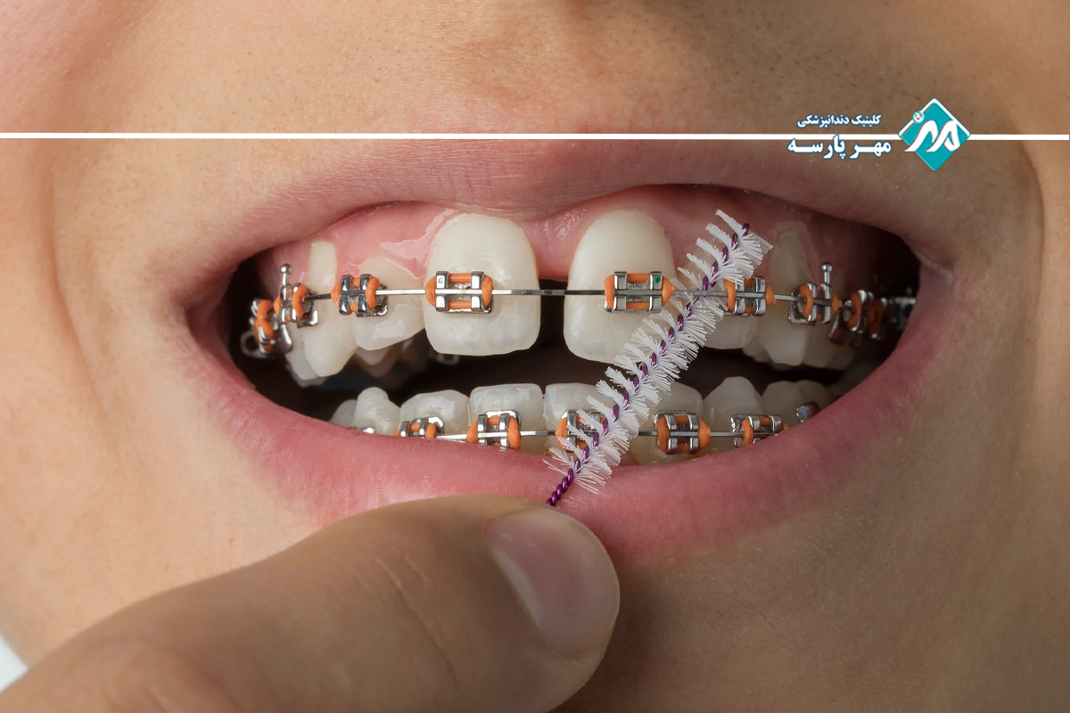 Orthodontics of one tooth