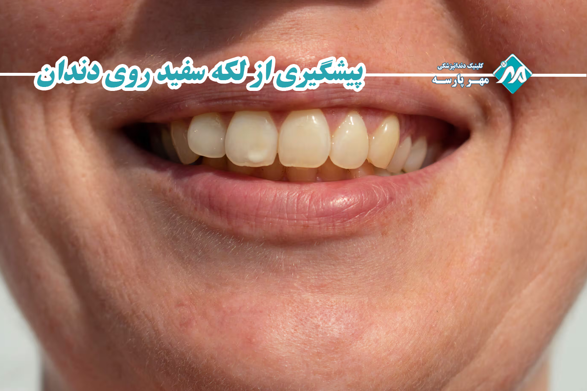 پیشگیری از لکه سفید روی دندان