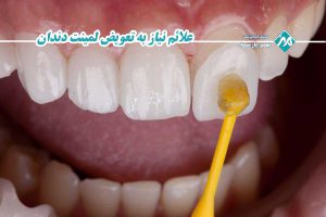 علائم نیاز به تعویض لمینت دندان