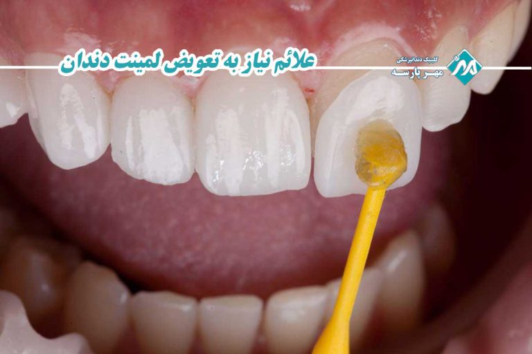 علائم نیاز به تعویض لمینت دندان