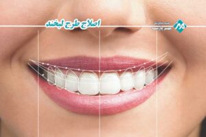 اصلاح طرح لبخند