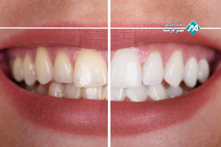 سفید کردن دندان با هیدروژن پروکساید