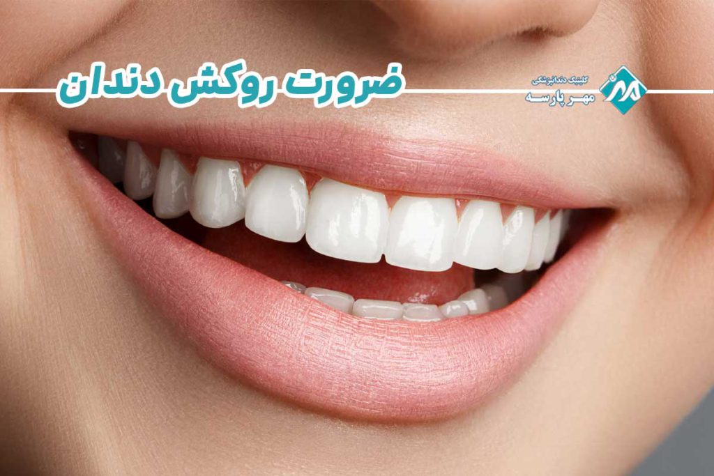 ضرورت روکش دندان