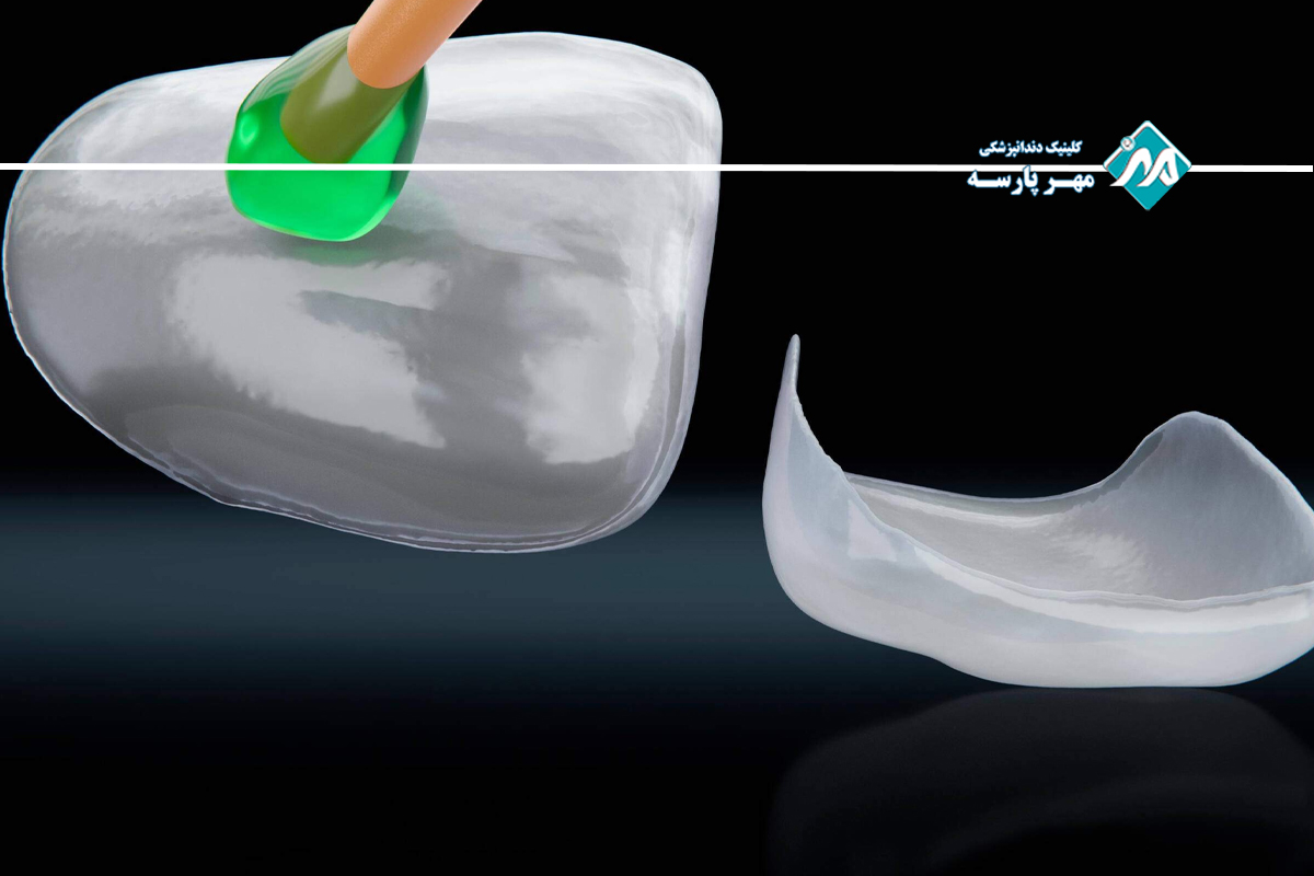 فرایند انجام لمینت دندان در غرب تهران