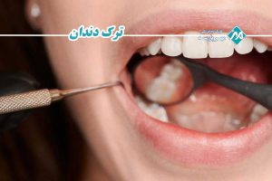 ترک دندان