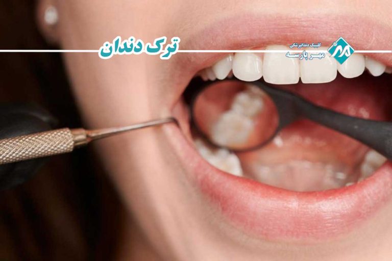 ترک دندان