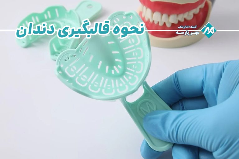 قالبگیری دندان