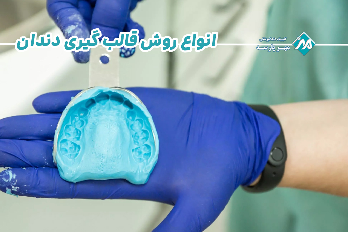 انواع روش قالب گیری دندان