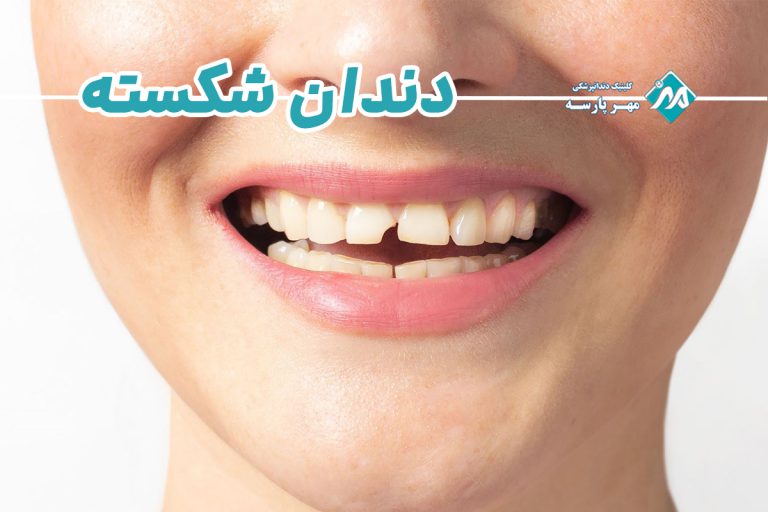 دندان شکسته