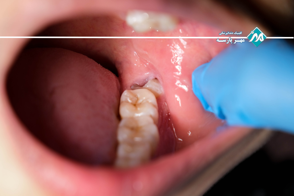 عفونت لثه
