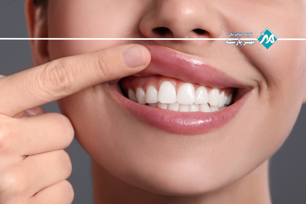 اصلاح لبخند لثه ای