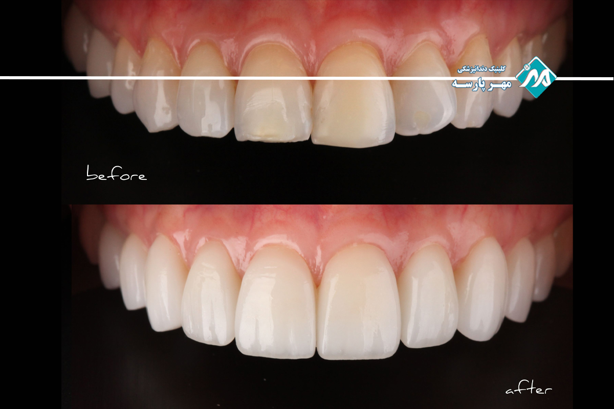 عکس قبل و بعد لمینت دندان در غرب تهران